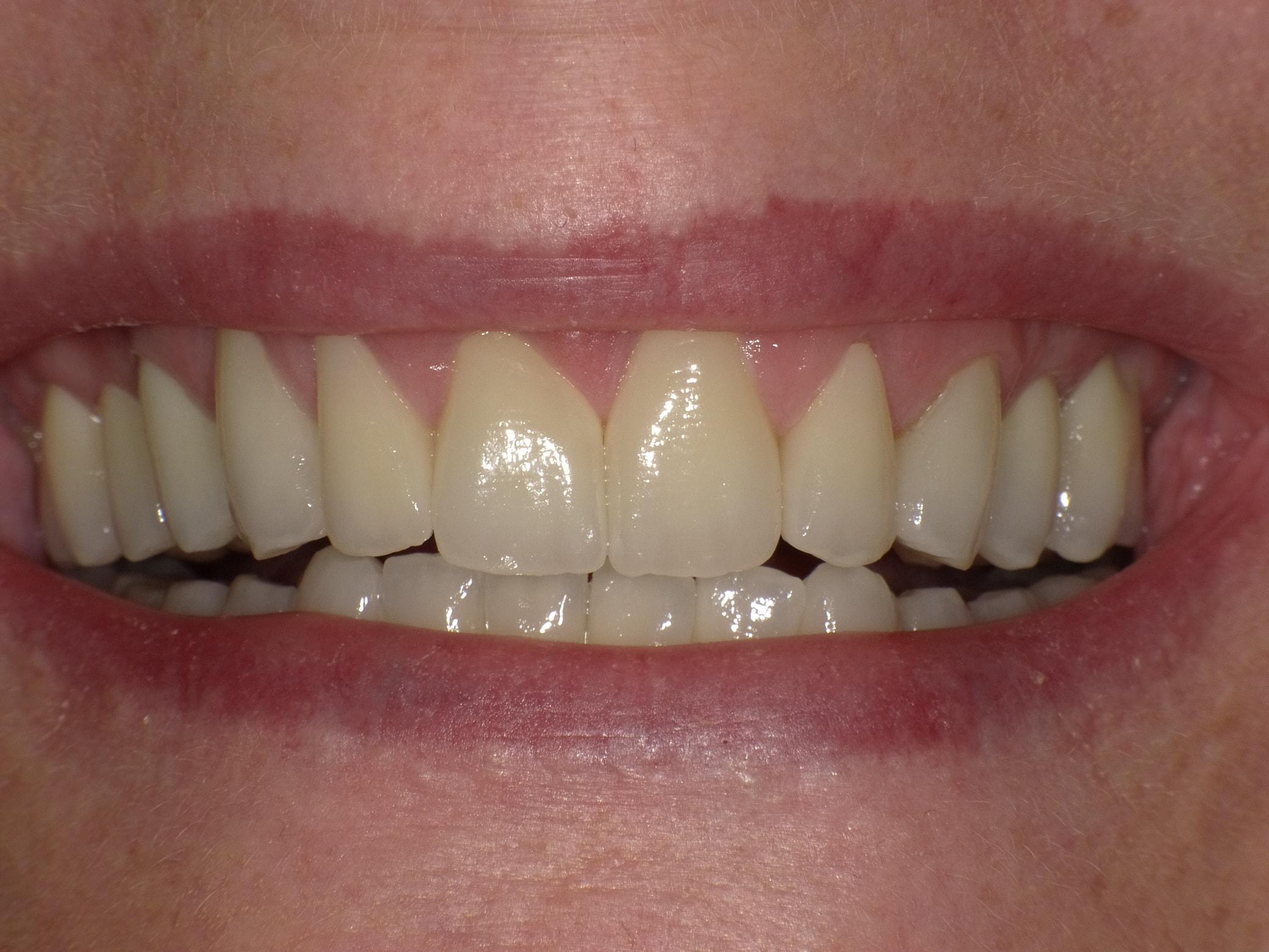 Idealisierung im Rahmen einer Komplettbehandlung mit Vollkeramik; Ersatz der nicht erhaltungsfähigen Zähne durch Implantate